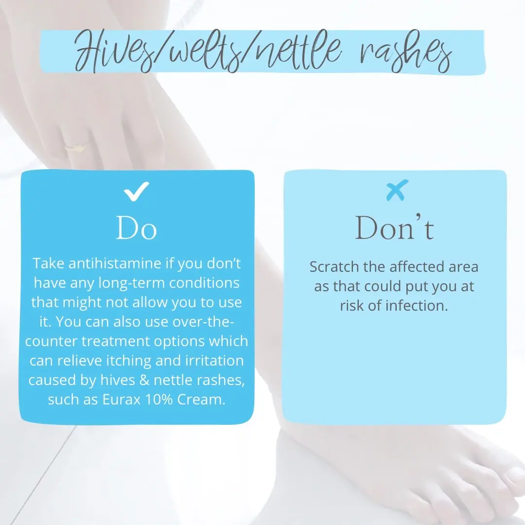 tips for hives, welts and nettle rashes